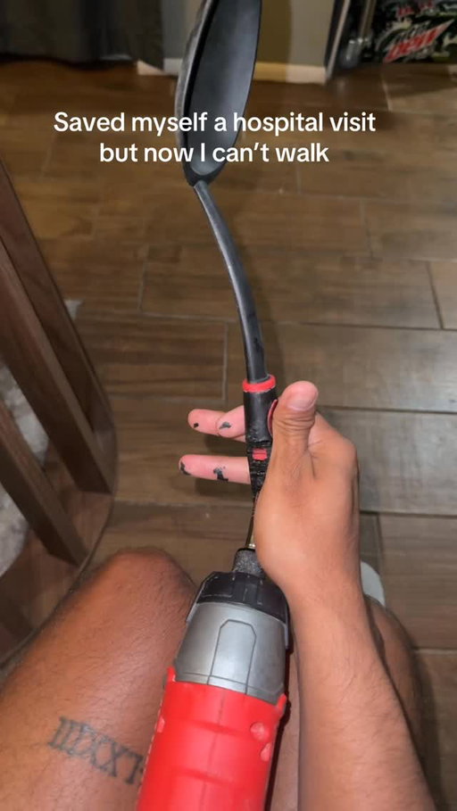 If it’s not one thing it’s another 🤦🏽‍♂️🤕🩼 #FusedHand #Update #Melted #Knee
#SpoonHands