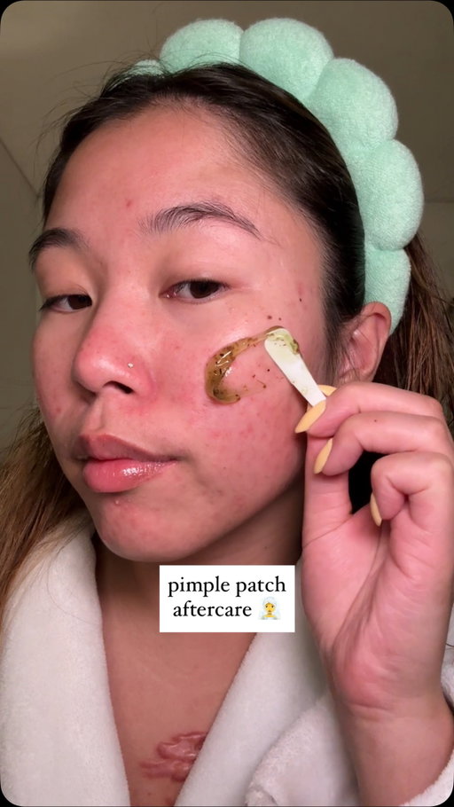 pimple patch aftercare 🧖‍♀️
--
product used:
@axisy_official new skin resolution gel mask
--
#axisy #axisygelmask #kbeautyskincare #skincare #koreanskincare #kbeauty #glowserum #glowyskin #glassskin #pimplepatch #acneskincare #acne