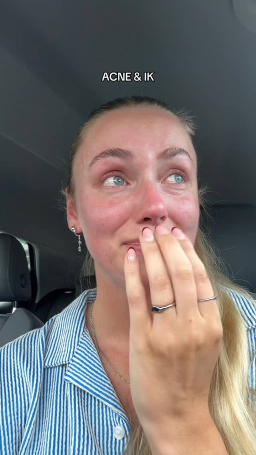 Boos en geïrriteerd is een understatement, maar ik blijf doorzoeken naar een oplossing. Het is wéér een acne journey, maar ik zal al mijn probeersels en bevindingen delen in de hoop dat wellicht 1 iemand er baat bij heeft die zich net zo als ik keer op keer niet gehoord voelt ❤️