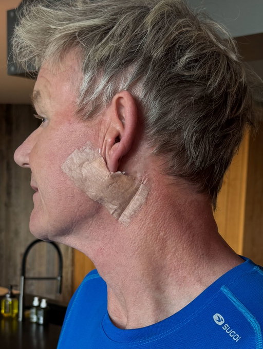 Grateful and so appreciative for the  incredible team at The Skin Associates and their fast reactive work on removing this Basal Cell Carcinoma thank you ! Please don’t forget your sunscreen this weekend ❤️I promise you it’s not a face lift! I’d need a refund…….😜