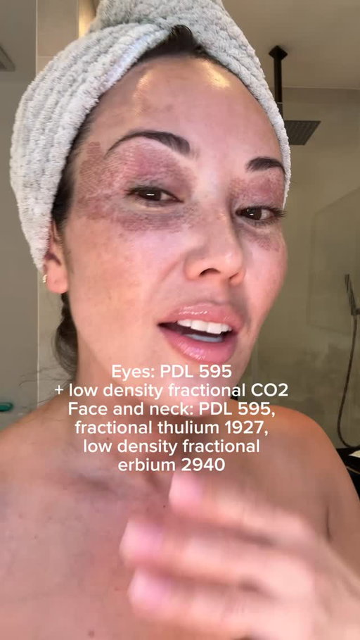 Got CO2 Laser Resurfacing and Fraxel done on my face a few days ago, so I just want to show you the post-care products @skinandsweat sent me home with afterwards.