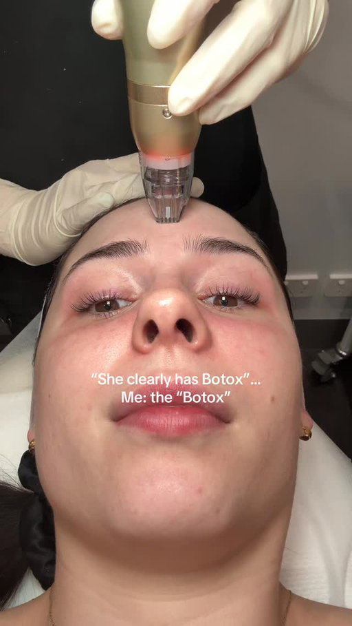 Not Botox girl but this is definitely more beneficial in the long run!

Sylfirm X, the only dual-wave RF microneedling device that delivers faster, noticeable results with minimal discomfort & downtime. With pulsed & continuous RF technology, it effectively treats pigmentation, skin tightening, rosacea, scarring, pores & fine lines, all in one device!

This is my 3rd treatment & im already noticing all the promised results!

📍 Silk Laser Clinic Double Day 

This is a gifted experience ( I have also paid for this before xx )