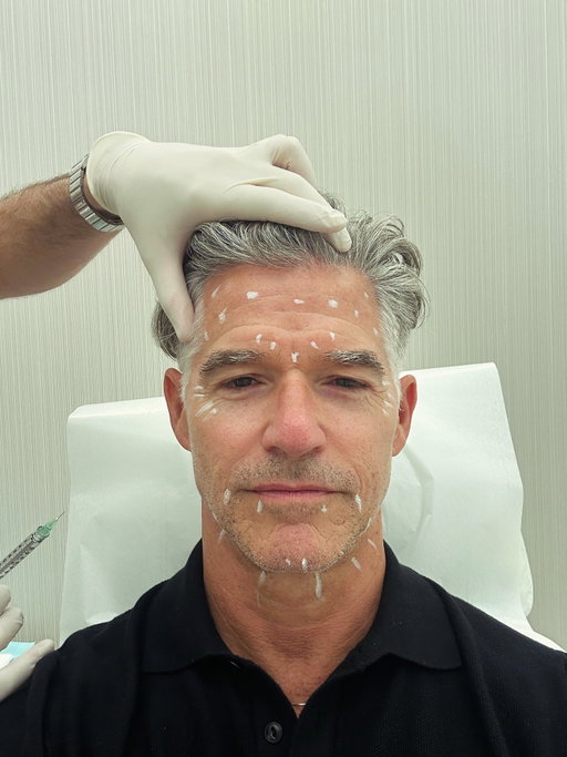 When your laugh lines are so deep they make you cry…with more laughter🪞#aginggracefully #wrinkles After my birthday, I decided I needed a little help to soften the hard edges. I went to see my friend @drdanbelkin at @nydgwellness