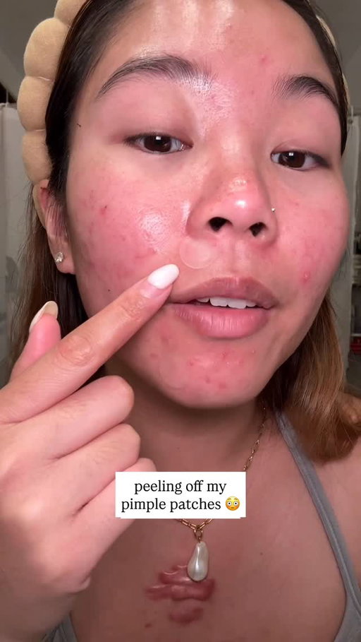 these were some gunky peels 😌 you can find @livaclean on Amazon #pimplepatch #skincare #acne #disposabletowels #skincaretowel #pimplepatchpeel #acneskincare