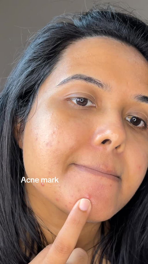 ✨ One spot, big difference ✨ Watch how my skin clears up day by day with the @purito_official Mighty Bamboo Panthenol Cream 🌿 
A real post-acne cream that soothes, restores, and brings back the glow ✨💧

#purito #PanthenolCream #AcneTreatment #RealPostAcneCream #RealPostAcneCreamChallenge