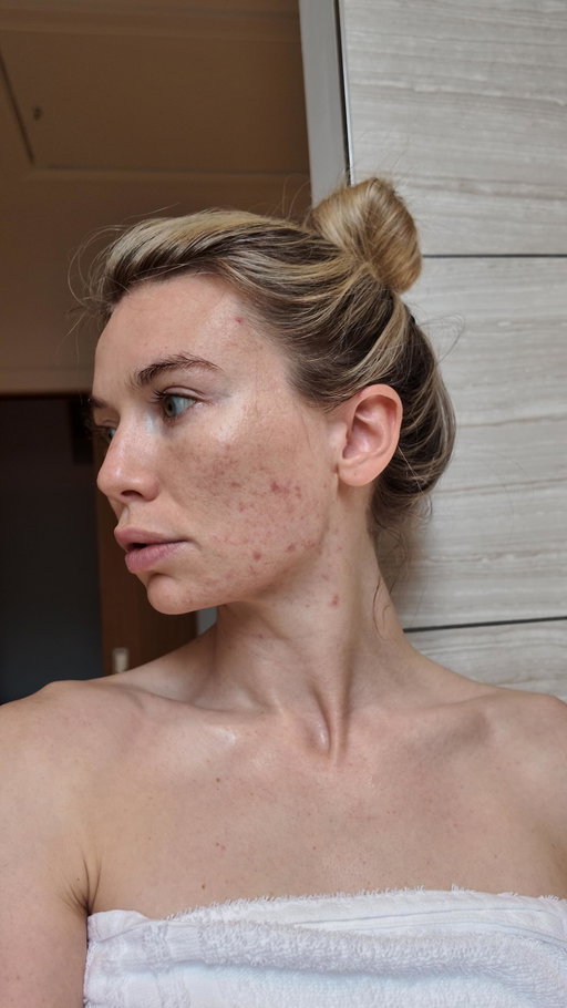 I never thought I’d still be battling severe acne at 30.

My skin has been my biggest struggle for as long as I can remember. The ups and downs, the flare ups, the way it can dictate how I feel about myself in an instant. It’s relentless.

But documenting my skin from May through to September has taught me something important: healing isn’t about reaching ‘perfect’ (because there isn’t such a thing!!). It’s about noticing the shifts, being kinder to myself on the hard days, and remembering that happiness can exist alongside struggle.

Here’s what I’ve learnt along the way:
🤍 Progress isn’t linear: and that’s completely okay.
🤍 Kindness to yourself is everything: speak gently, especially on bad skin days.
🤍 Life goes on: living fully isn’t cancelled because of breakouts.

If your skin feels like your biggest enemy right now, please know this. You’re not alone, and you are so much more than what you see in the mirror xxxx