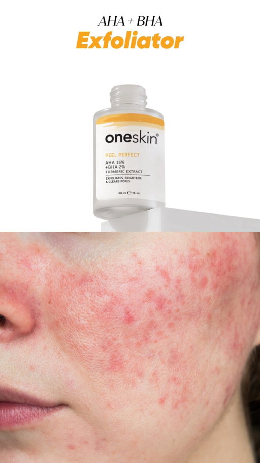 Peel perfect solution from @oneskinofficial , use it twice a week at night, see visible results in just two weeks. 💛