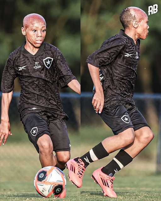 This is so incredible. Meet Bernardo Lopes, a young aspiring footballer from Rio De Janeiro, who just made his debut for Botafogo’s academy.

At just one years-old, he had a terrible accident at home. His mother warmed up a kettle to warm up his bath, but she quickly left the room to clean up, and he went to the kitchen and accidentally pulled the kettle with boiling water all over his face and body.

Many doctors thought he would die from the severe burns, but after 7 months of surgeries, skin grafts and time in hospital he was able to continue his story.

Ever since, he’s loved playing football. Started out just playing locally by his uncle’s house. He then joined a local academy, and recently played in a tournament in front of scouts… Where he got picked up by Botafogo. After a successful trial, he is now part of the academy & just played his first game.

A story of never giving up. He is so brave to go and play with confidence, and is not afraid or embarrassed about his scars… Instead he shows them to tell his story. Beautiful. ❤️🙏🏽