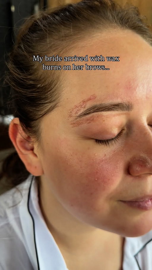 As a human your first thought is… holy fuck ouch. But as a MUA your first thought is… this is manageable. This is why you hire an experienced MUA for your big day: you never know what can happen the week leading up to your wedding. 

The biggest issue with burn covers is trying to conceal and match the texture of the burn AND without it looking too product heavy. I approached this with thin hydrating layers of color corrector, concealer and powders that went beyond the actual burn to trick the eye into thinking it’s not even there! 

Layer 1: moisturizer 
Layer 2: green color corrector 
Layer 3: powder
Layer 4: concealer 
Layer 5: powder 
Layer 6: concealer 
Layer 7: powder 
Layer 8: powder foundation 

Can you even tell? 

HAIR & MAKEUP BY ME

#makeupartist #makeup #mua #makeuptutorial #destinationmakeup #destinationmakeupartist #winnipegmakeupartist  #manitobamakeupartist #canada #canadamakeupartist #winnipegmua #canadianinfluencer #makeup #plussize #curvy #hair #hairstyle #winnipeghairstylist #bridalhair #hollywoodwave  #travelmakeupartist #bride #bridalmakeup #hair #bridalhair #hairstylist #hairstyles