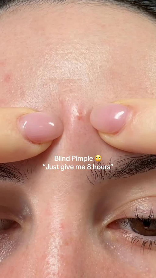 Blind Pimple 0 @garnieraunz Invisible Pimple Patches 1 👏🏻 AD. #pimplepatch #hadnochance #dontpick #garnieraunz #garnierskin #garnierpimplepatch