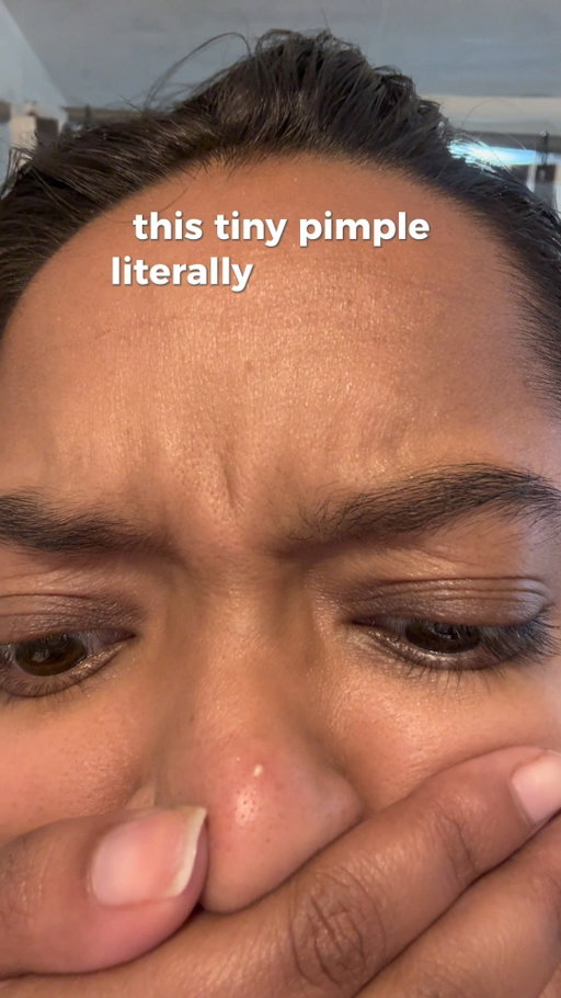 Our Proactiv Zits Happen Patches use hydrocolloid technology to treat pimples fast, reduce breakouts, and flatten acne overnight. 💫

They also protect against picking, help prevent acne scars, and speed up healing — your go-to acne treatment for clear skin. 🩵