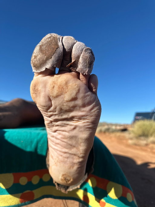 Most people look at my feet after a race and cringe. Blisters, missing and black toenails, skin peeling off,  trench foot in this picture- pure destruction. 

But that’s the point. Those feet tell the story of suffering. Every mile, every hill, every moment I wanted to quit but didn’t — it’s all written right there. 

Pain leaves a mark, and those marks remind me who the hell I am. Comfort doesn’t teach you anything. Suffering does. My feet aren’t ugly — they’re proof of a war I survived.  The most recent being Moab 240 this past weekend. 

I look at my feet and am proud of the work they endured and the fact that I am still lining up at the start line of these races twenty years after I started when so many of my generation have long since retired. 

Stay hard!