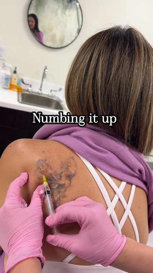 8 sessions in… and we’re getting closer! 👏 Laser tattoo removal is definitely a process — two different lasers are used: one for the black ink and one for color. Sessions are spaced 8–12 weeks apart to let my skin heal and the ink flush out. I’ll probably need 3–4 more sessions, but it’s worth it to see it almost gone. 💫 

Have you had a tattoo removed?