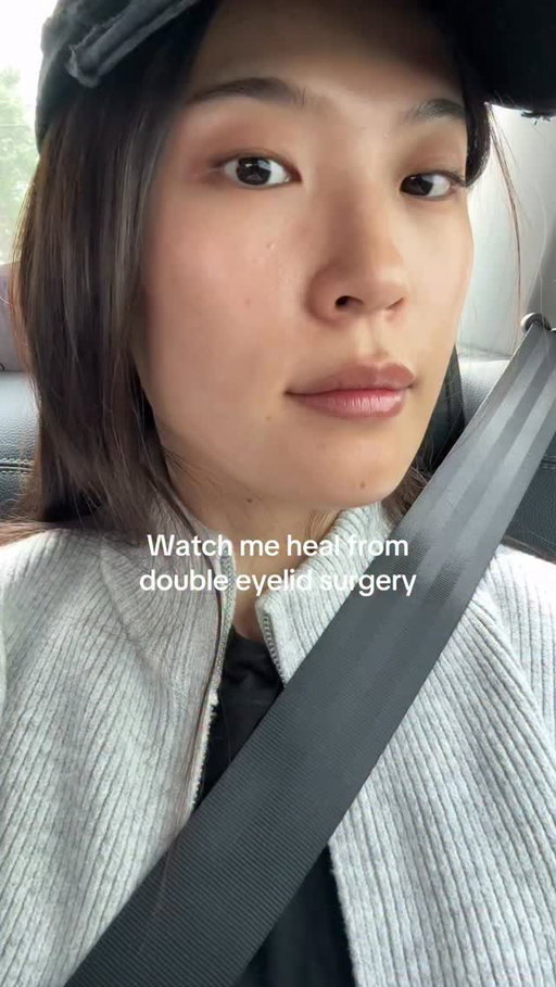 Healed dramatically after the sutures were removed!

Disclaimer that I am documenting my healing journey and I am not promoting surgery.

#HealingJourney #doubleeyelid #doubleeyelidsurgery #seoul #blepharoplasty #cosmeticsurgery