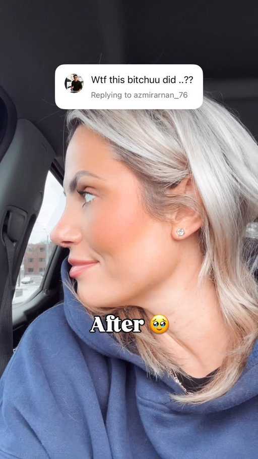 🤷🏼‍♀️ I’m that bitch. 

#nosejob #rhinoplasty #beforeandafter