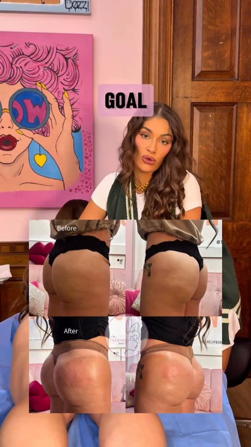 project build a booty 💉🍑 Ask me about SCULPTRA BBL

Treatment: Sculptra 🍑
Results: 2-4 years ⏱️
Downtime: none 👏🏽
Price: Book a consult 🐰