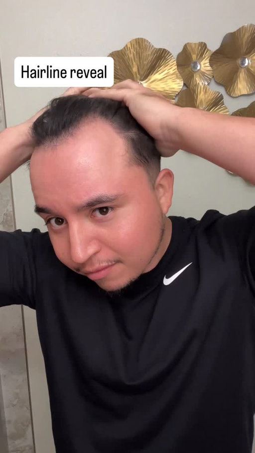 Getting that Hair Transplant Surgery @haircenterofturkey 🙌🏻 #reels #hairtransplant #hairtransformation