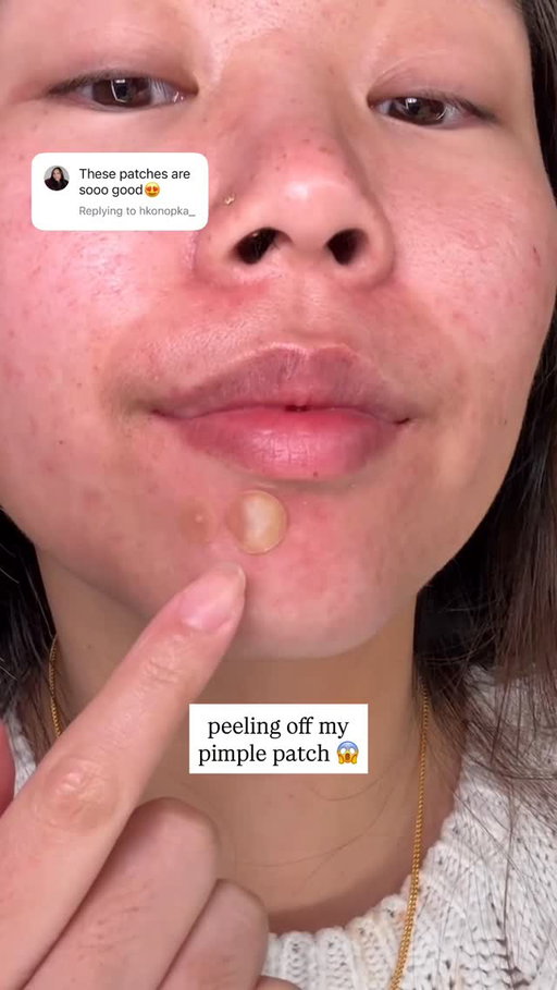 can confirm these patches work so well 😌
--
@neutrogena acne patches
--
#acne #skincare #pimplepatch #acneskincare #pimplepatchpeel