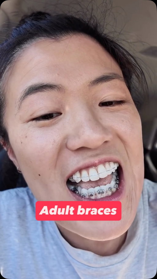I made a huge decision that I’ve been thinking on for a 10+ years 😳 I got braces!

Watch me re-learn to talk in real time hahaha.

One year of braces, then jaw surgery and another year of braces. It will fix my underbite and help with speaking + feeling like my teeth actually fit properly in my mouth. I figured if I live for another 50 years that’s a long time to not have the right bite 🥴

There’s no point hiding away so I welcome you to come on this journey with me as a comedian and adult brace face. There’s already so much material in this so that is a huge bonus! 

Have you had braces? Especially adult braces - let me know what you remember about it and how you ended up 🦋
