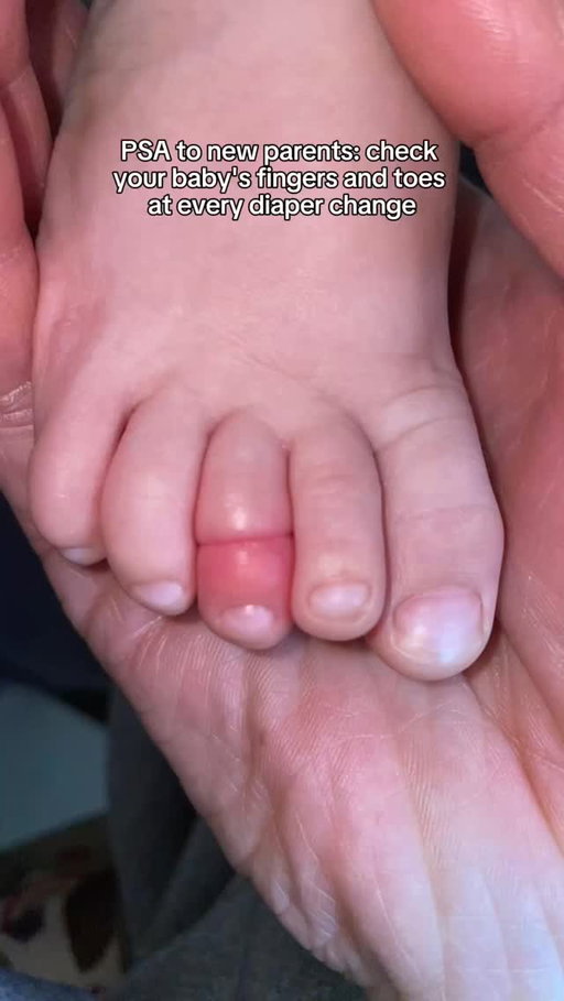 Have you ever heard of a hair tourniquet? This is a term for when a piece of hair or thread from clothes or a blanket get wrapped around a child’s toe(s) or finger(s). It can happen with other parts of the body like ankles, wrists, tongues or genitals.
If baby is inconsolable though you’ve tried everything (diaper, feeding, walking, cuddles), check out their digits!
A mom tip we have seen shared is to have a toolkit handy consisting of small nail clippers or nail scissors, tweezers and even Nair! These can be helpful in removing that tangled hair from baby’s body but if you are unable to remove it quickly, seek medical help ASAP! The hair can become tight enough that it blocks blood flow to the area and can damage tissue.
Do frequent checks of baby (every diaper change is a good time!) and also of their clothing and blankets to trim any loose threads.
Have you ever experienced this before? How did you manage?
#hairtourniquet #parentpsa #babyhair #babytips #newmom