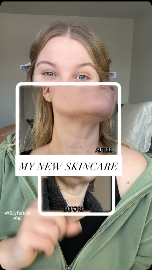 #ad #OlayPartner I’ve found it! A couple months ago I started noticing some new loose skin and wrinkles around my neck and jawline and knew I had to start taking care of that skin in a new way.
 
I’ve partnered with @Olay (!!!) to show you exactly what I’ve been using to treat both my face and neck.
 
First… can you believe the before and after?! The Olay regenerist face and neck lifting treatment is really WORKING! Paired with the micro sculpting cream, I am seeing noticeable results and can’t wait for you to try.
 
Click the link in my bio to try for yourself.
 
Love you BYE
 
#skincare #selfcare