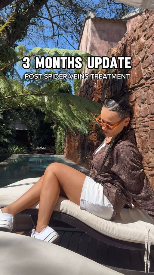 My 3 months update post Spider Veins Treatment at @metroveincenters ❤️ If you ask me, I’ve never been more confident in my legs, you can’t get me to cover them up now lol… If you’ve been thinking about sclerotherapy or any veins treatment, now is the perfect time to get it done if you want to be summer ready, as final results don’t fully appear until 3 months after. Thank you #MetroVeinCenters #MVCPartner #maryamnyc #spiderveins