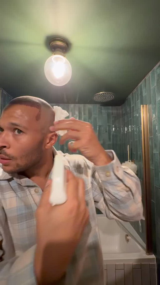 8 days post op & i’ve got a new hairline lol 🤷🏼‍♀️
full vid of the actual transplant on my youtube now