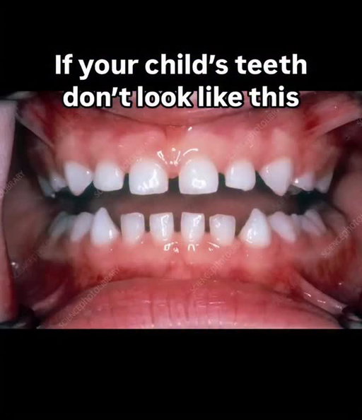 Your child’s baby teeth SHOULD have spaces between them. 

If they don’t, that’s not “cute”—it’s a red flag. No spacing = ❌ Jaw isn’t growing wide enough 
❌ Not enough room for adult teeth (crowding is coming) 
❌ Higher risk of a narrow airway 
❌ Possible muscle dysfunction or mouth breathing Yes, spacing matters. 

Yes, this shows up early. 

Yes, it’s preventable if caught in time. 
✅ Spaced baby teeth = a jaw that’s growing forward and wide 
✅ Room for adult teeth to erupt naturally 
✅ More space for the tongue and a healthier airway 
✅ Better breathing, sleeping, and development 

You won’t hear this at most dental checkups. But airway dentists look at the whole picture—not just cavities. Want my full Airway Checklist for parents? 👉Follow & comment “AIRWAY” and I’ll DM it to you. 

This one’s worth saving—and sharing with anyone raising kids. -Dr. B