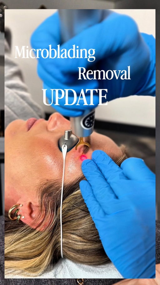 Microblading removal update… and yes, my brows turned yellow!!! 

What I thought would be fairly straightforward has been anything but - sharing the real timeline, surprises, and what I’ve learned so far.

If you’ve ever considered microblading (or removing it), this one’s for you.