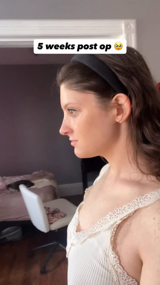 It’s amazing how life changing and beautiful FFS is😭

My daily dysphoria has been lifted nearly completely and for the first time in 13 years I’m not chronically thinking about some of the more masculine features I had  and being so self critical 😭 feels so freeing

For those wondering what was done. I had type 3 brow reconstruction /orbital shaving/ brow lift and rhino/septioplasty 

Still a bit swollen and even more so cuz my nose got bumped kinda hard recently but even with that I feel so much more whole. 🥹