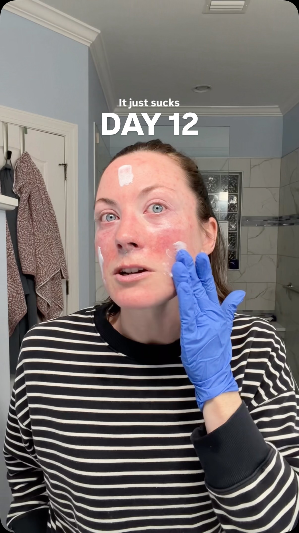 Day 12. My PM Skincare routine and prep before my 5-FU (fluorouracil) cancer cream treatment. This is a topical chemotherapy!

Please check out my other videos for more context and my skin cancer journey.

Comment SKIN and I will send you links to my creams and favorite spfs (also linked in bio)

#skincancer #fluorouracil #basalcellcarcinoma  #bcca