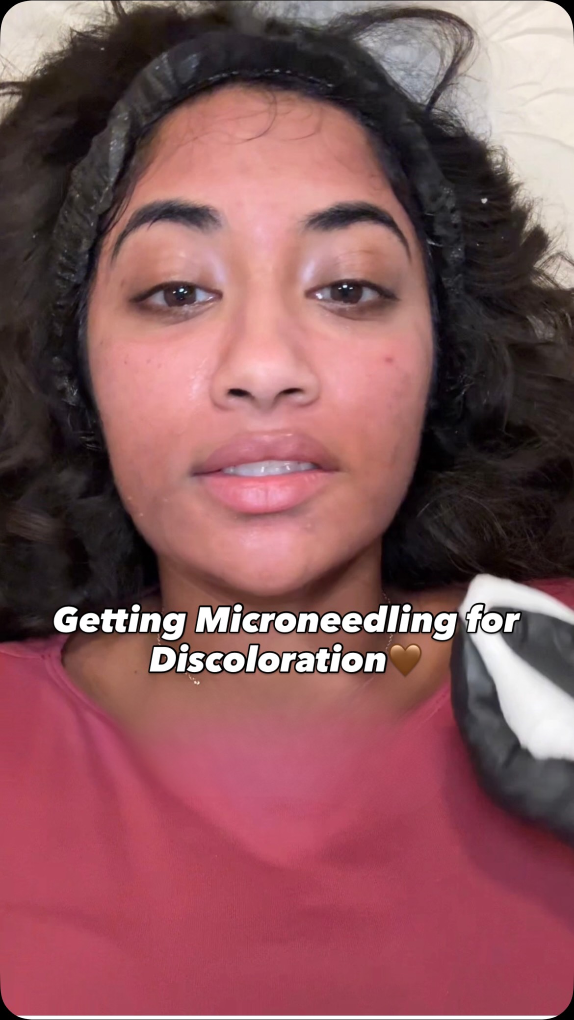Dealing with adult acne has been such an emotional struggle for me. After changing up my skincare routine for the past few weeks, I’m getting microneedling done to help with dark spots and hyperpigmentation on my brown skin 🥲 

#microneedling #darkspots #hyperpigmentation #adultacne #browngirl