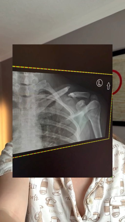 a broken collarbone, bad concussion and 4 stitches on my head. Surgery tomorrow to put my collarbone back together… more updates to come.

thank you to everyone for the kind messages of support already and also thank you to my amazing team who got me back home to Canada comfortably @cyclingcanadaofficial and a HUGE thank you to @nickwammes for taking care of me during one of the toughest weeks ❤️