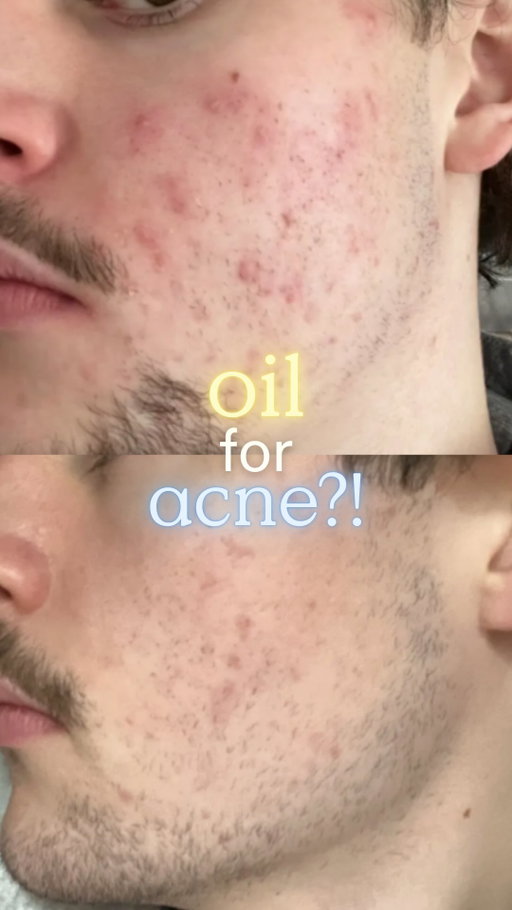 I thought I had to scrub off my pimples like a dirty dish🥹

Ten years ago, I was selling acne products for one of the biggest beauty companies in the world and still breaking out on my own face. I did everything they told me to do. Harsh cleansers. Drying treatments. Scrubs. I declared war on my own face and called it skincare.

What nobody told me was that acne-prone skin is actually starving for linoleic acid—a fatty acid that keeps your barrier healthy and your oil production balanced. And the richest source of it? Oil. The exact thing the industry told us was the enemy.

When I figured that out, I felt like I’d been scammed my whole life.

So I made Oil La La. A lightweight oil serum that works with your skin instead of against it—because a skin that never heals is a customer that never stops buying, and I refused to be part of that anymore.

Oil La La officially launches tomorrow at kravebeauty.com, @amazon, @cultbeauty 🩵💛

Comment OIL and I’ll send you the link to get it early 

#OilLaLa #KBClassofReset