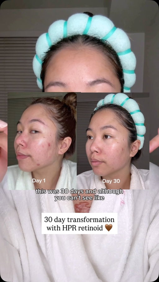 Don’t be fooled by “7-day transformations”. A real 30 day skin transformation using @rejuall_official advanced retino-mela serum 🤎 #rejuall #rejuallserum #rejuallretinoid #koreanpharmacy