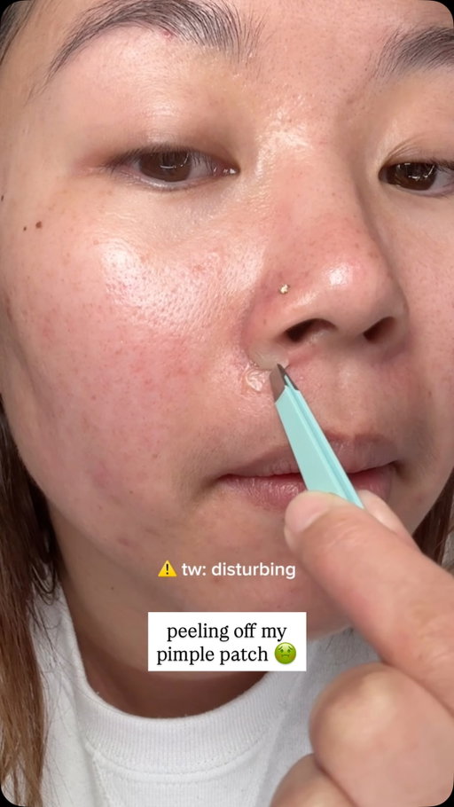 i havent had a super juicy peel in a while 🫣 
--
@panoxyl overnight patches
@tower28beauty sos spray
--
#acne #skincare #pimplepatch #acneskincare