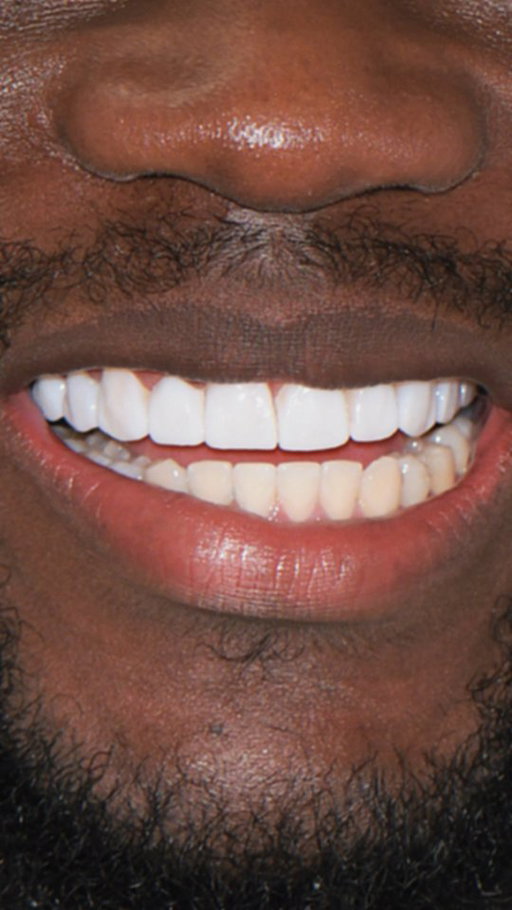 VENEERS!

From Insecure to Unstoppable 

They used to hide their smile…
Now it lights up every room. 
This is the power of veneers 

Instantly whiter teeth
Perfectly shaped smile
Confidence on 100

No filters. No hiding. Just a brand-new smile that speaks before you do.

Because sometimes, the only thing standing between you and your best self…
is your smile.

Ready for your own transformation?
Send us a DM or book your consultation today.

#SmileTransformation #Veneers #ConfidenceBoost #PerfectSmile #DentalCare SmileMakeover LagosDentist