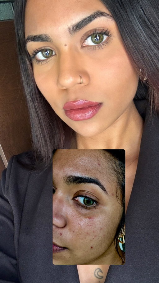 Hate to say you were right (as if your not always ) but thank you #mom for introducing me to @proactiv safe to say I couldn’t have done it without you ❤️
•
•
•
#proactivpartner #reallife #rant #skincare