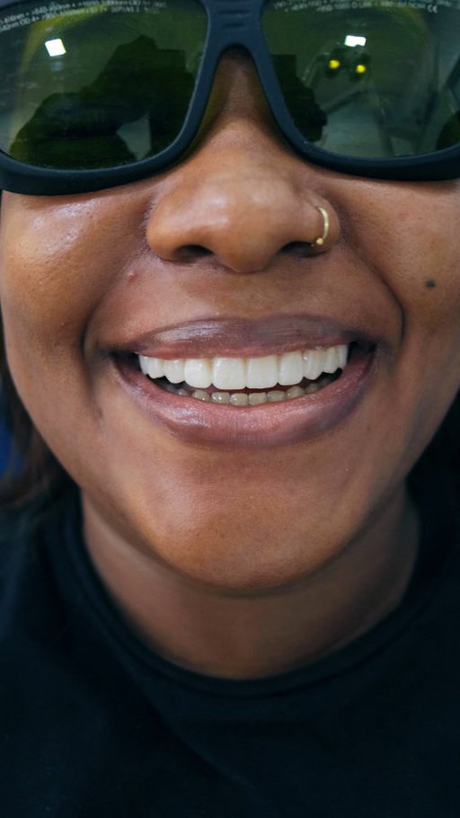 She didn’t just fix her smile… she found her confidence again.

What you’re seeing isn’t just a smile transformation,  it’s a life transformation.

From hiding her teeth…
To smiling boldly in every room she walks into.

That’s the power of veneers, designed not just for beauty, but for confidence that shows up in every conversation, every photo, every moment.

Because when your smile feels right, everything else follows.

Ready for your own transformation?

Let’s create a smile that reflects the best version of you.