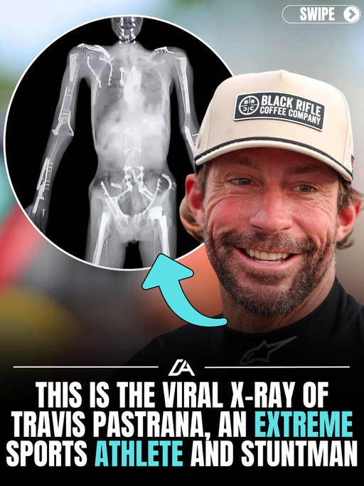 A viral X-ray of stunt legend Travis Pastrana has fans doing a double take… because it doesn’t even look human. It’s a full blueprint of metal plates, screws, and surgical repairs scattered across his body… the kind of image that instantly shows what decades of extreme sports really cost behind the scenes. 

Pastrana’s injury history is on another level. He shattered his pelvis at just 14 years old, broke his back multiple times, tore his ACL and MCL repeatedly, and has suffered over 60 concussions throughout his career. He’s undergone dozens of surgeries just to keep functioning… let alone keep competing. And somehow, in between all of that, he still became a multiple-time X Games gold medalist, a motocross champion, and the first person to land a double backflip on a dirt bike in competition.

What makes this even crazier is that this kind of “internal hardware” isn’t unheard of in high-risk sports… but the volume inside Pastrana’s body is extreme even by those standards. Plates stabilizing fractures, screws holding joints together, and surgical repairs layered over years of trauma. His body has essentially been rebuilt piece by piece just to keep up with the demands of what he does.

This is the side of greatness most people never see. The crashes don’t end when the cameras cut… they turn into months of rehab, permanent limitations, and a body that will never feel “normal” again. Every record-breaking jump, every viral moment, every insane stunt comes with a hidden cost that adds up over time.

And it raises a real question… when you see what it actually takes to live that life… is it worth it to be a stuntman? 🤔

#nitrocircus #travispastrana #extremesports #motocross #xray