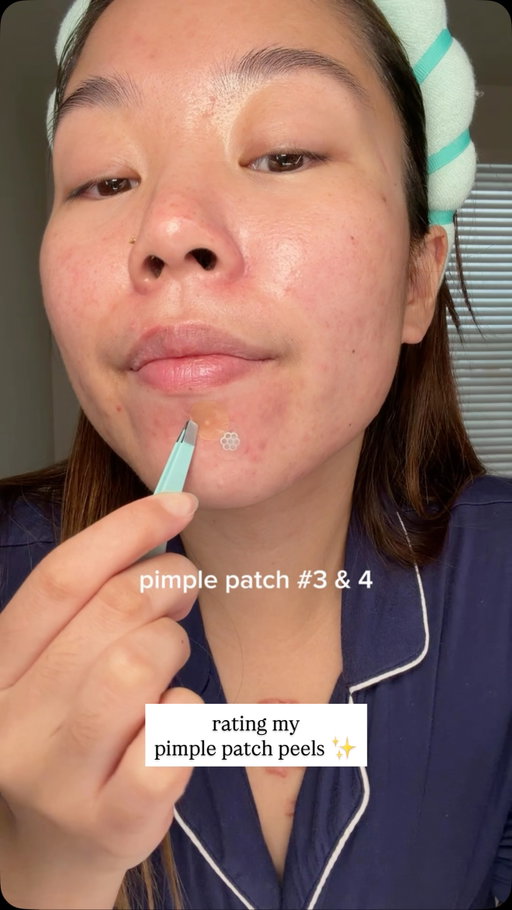 peeling off my pimple patches after 8+ hours 😗 #acne #pimplepatch #skincare @peaceoutskincare @easyderm.official @neutrogena @topicals