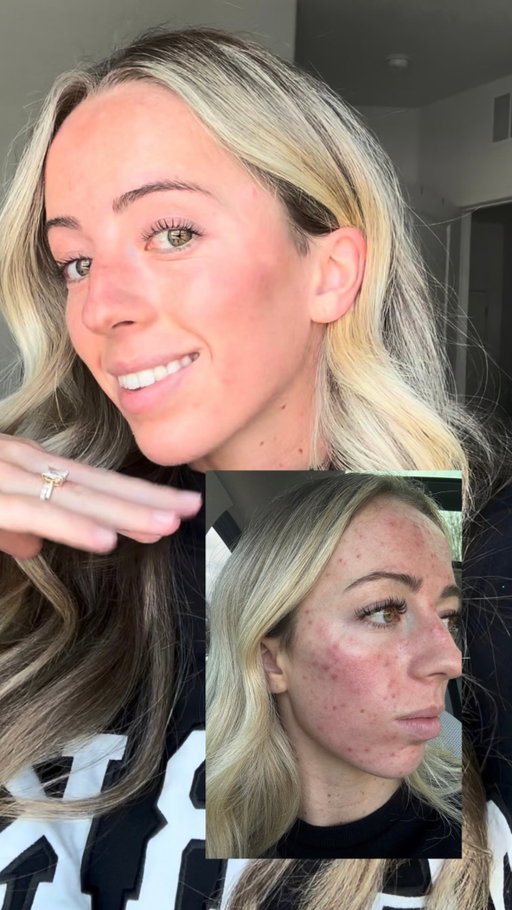 Thank you Mom for always being there when I was struggling with my acne! 
#proactivpartner #acne #acneproneskin #acnetreatment