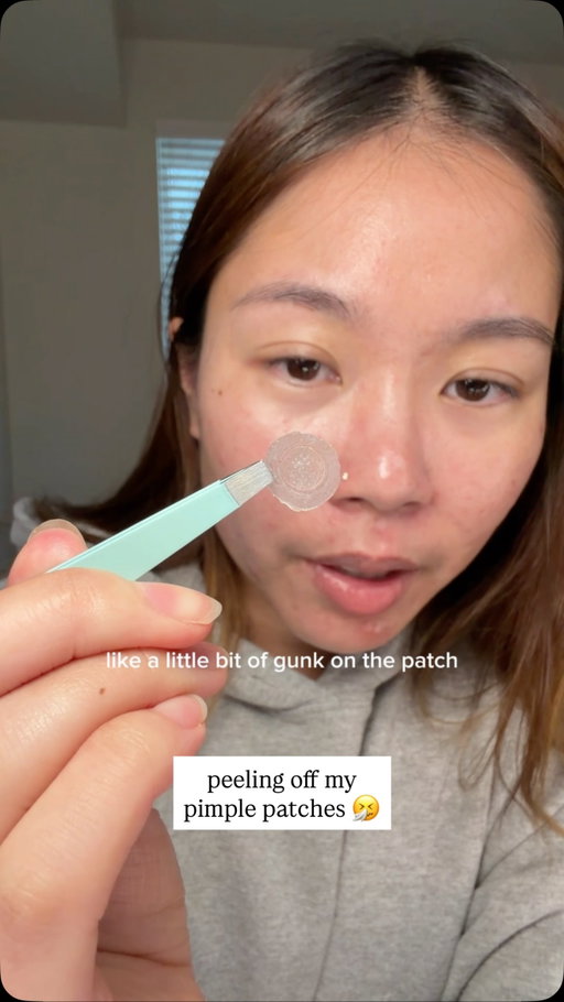 my cystic pimples are back 😭 #acne #skincare #pimplepatch #acneskincare @easyderm.official