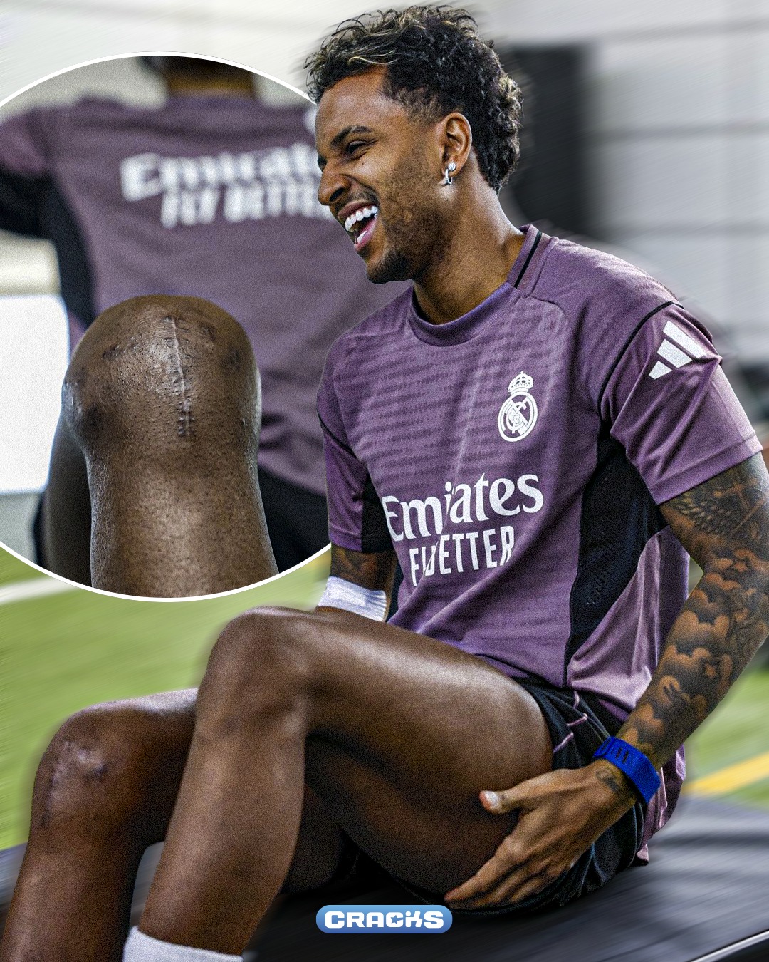 😔💔 RODRYGO MOSTRÓ SU DURA RECUPERACIÓN

📸 El brasileño subió una foto enseñando cómo avanza su rehabilitación… y también la gran cicatriz que le dejó la operación de rodilla

🏥 Rodrygo sufrió una rotura de ligamento cruzado anterior y menisco en marzo

⏳ El tiempo estimado de baja es de entre 10 y 12 meses

⚪ En el Real Madrid creen que podría volver recién entre enero y febrero de 2027

💪 Por ahora sigue trabajando día a día para regresar más fuerte
