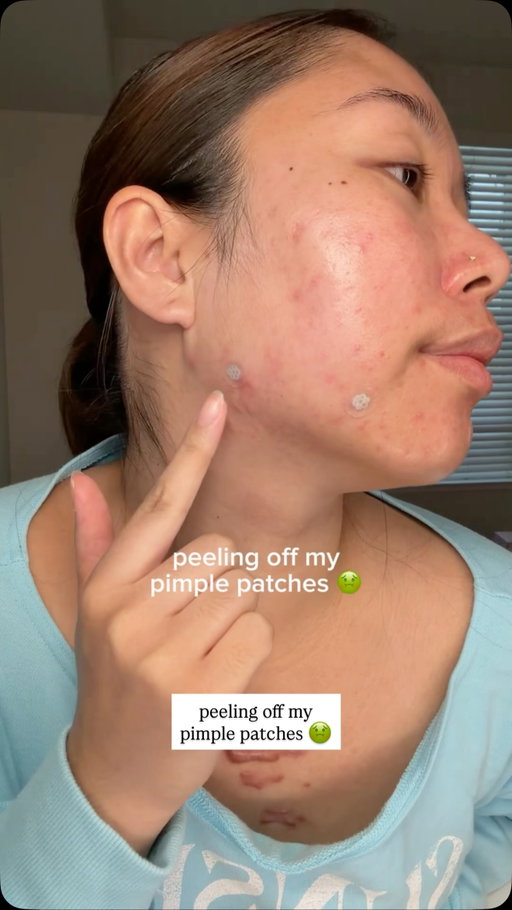help these pimples keep filling up my patches 😩  #acne #skincare #pimplepatch #acneskincare #koreanskincare @easyderm.official
