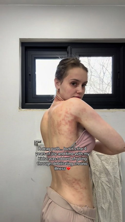For everyone saying it’s just “rashes” or minimizing the mental and physical toll severe skin conditions can have on someone, it can completely take away your quality of life, your will to live, and leave lasting effects on every part of your life. Looking back at these videos is super triggering, but also such a reminder that healing is possible. I remember being at my absolute lowest mentally and physically with my health like it was yesterday, and I would’ve begged to be where I’m at today. So for that, I’m so so grateful for the progress and continued healing🙏🏼