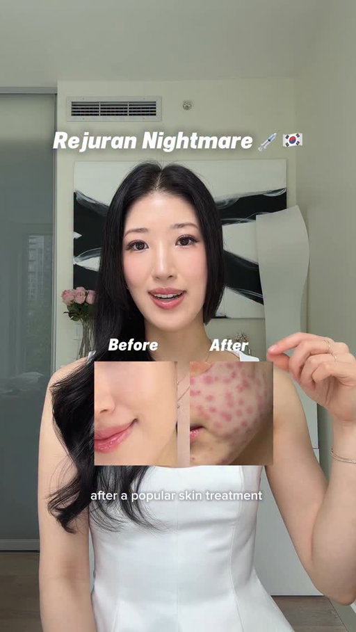 My nightmare Rejuran experience in Korea 💉🇰🇷

The clinic made me sign a contract to not reveal the clinic name and gave me $93 back as compensation of the $400 treatment cost 😀

#rejuran #skinbooster #kskincare #koreanskintreatment