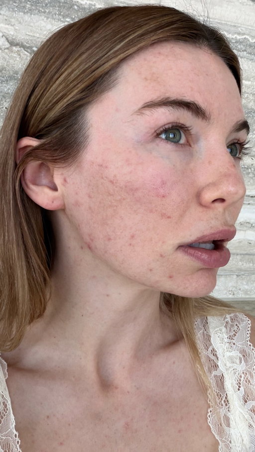Bacne. At 31. For the first time in my life.

I can’t bear that I look like a different person in these photos. Every skin update I’ve shared lately has been when things were getting better, and that’s not where I actually am. So here’s the truth.

If you’ve found something that worked for yours, please send it. Products, doctors, derms, diet, anything. I’ll read every single one. And if you’re in it too, tell me that as well.