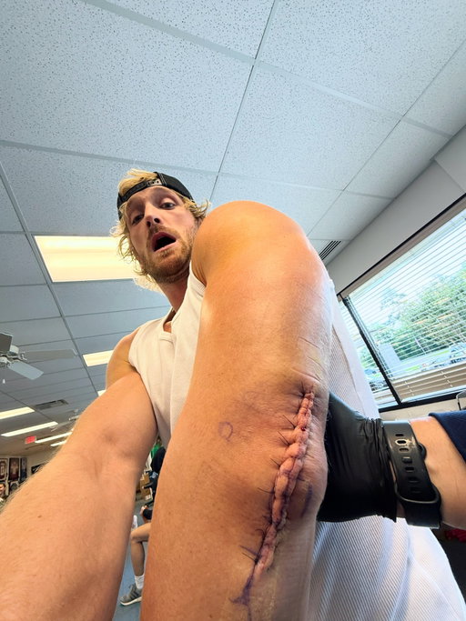 Tore my tricep, got surgery while wide awake, told doc I wanna feel it all. Still the Tag Team champ just FYI. They’re telling me 6 month recovery but I don’t believe them, I’ll be back in a couple weeks with some @drinkprime shake (32g protein). Good news I can still rip packs bc @ripit about to launch. Keep that title warm for me @wwe @austin_theory @paulheyman @bronbreakkerwwe. @bronsonishere let’s hang out