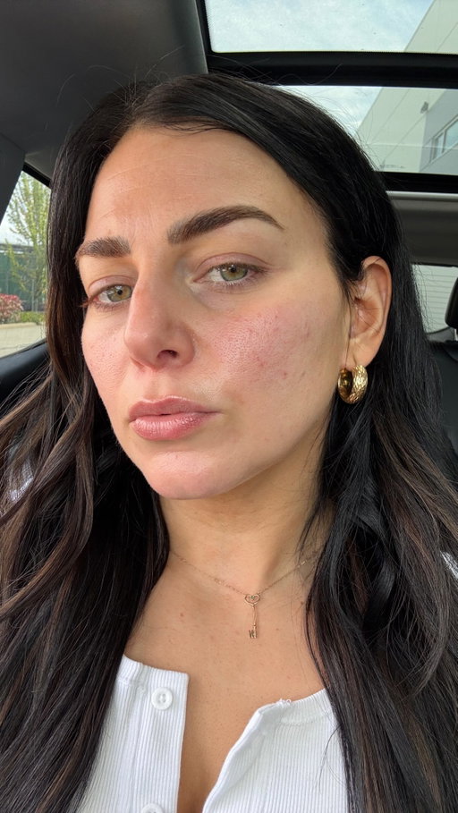3 years later and my answer is still yes — @aviclear by @cuterainc was one of the best investments I made for my skin. 🤍

I purposely filmed this in natural lighting with minimal makeup so you could actually see my skin because when I was struggling with acne, honest reviews helped me the most.

If you’re considering AviClear and feel frustrated with stubborn acne, this is your reminder that progress doesn’t always mean perfection — sometimes it just means finally feeling comfortable in your own skin again 🤍

All treatments done at @orchidmedicalclinic 

#AviClear #AcneTreatment #SkinJourney #AcneProneSkin #SkinConfidence BeautyCreator VancouverCreator RealSkin